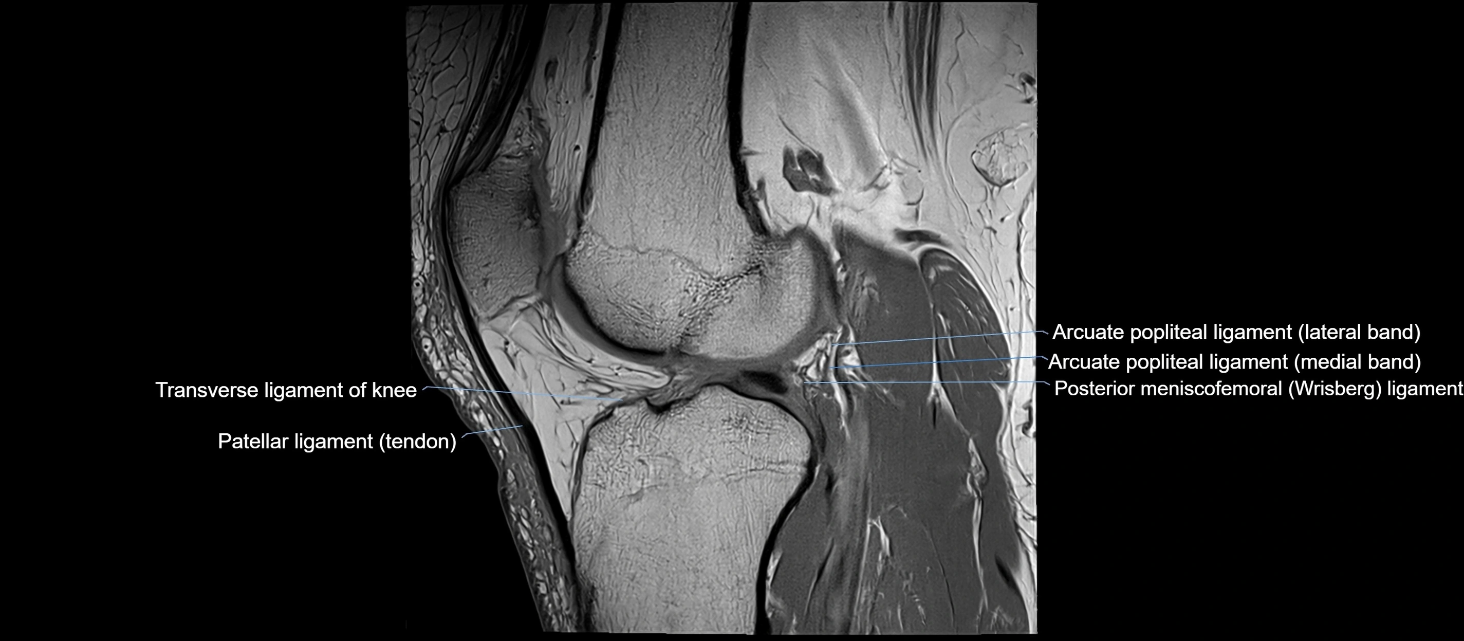 MRI sagittal  ligaments cross sectional anatomy 3T  radiology  image-img-00001-00028.webp